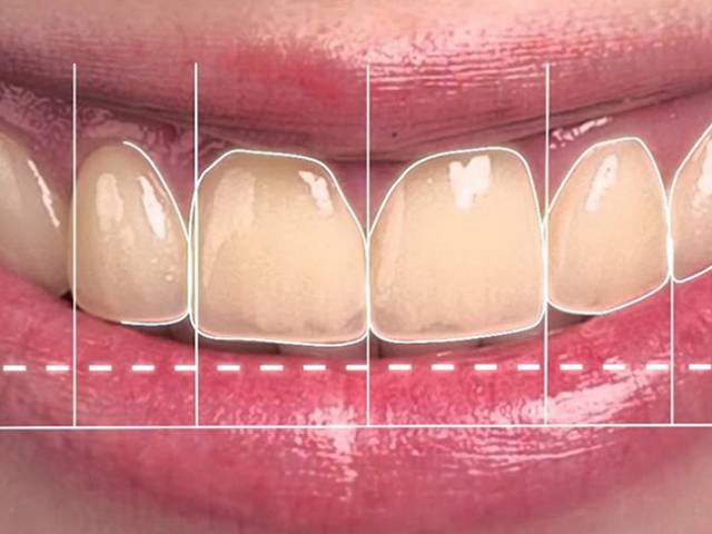 Smile Design & Dental Kroner