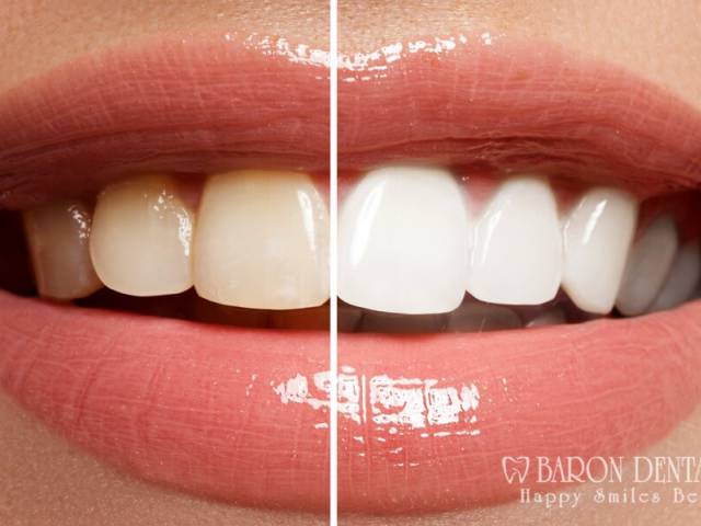 Bleaching | Bleichen Antalya