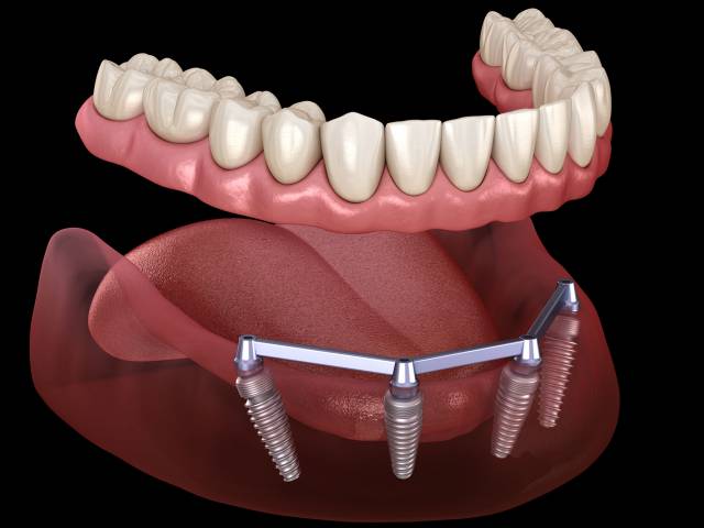 Implant Supported Dentures Side / Antalya Turkey